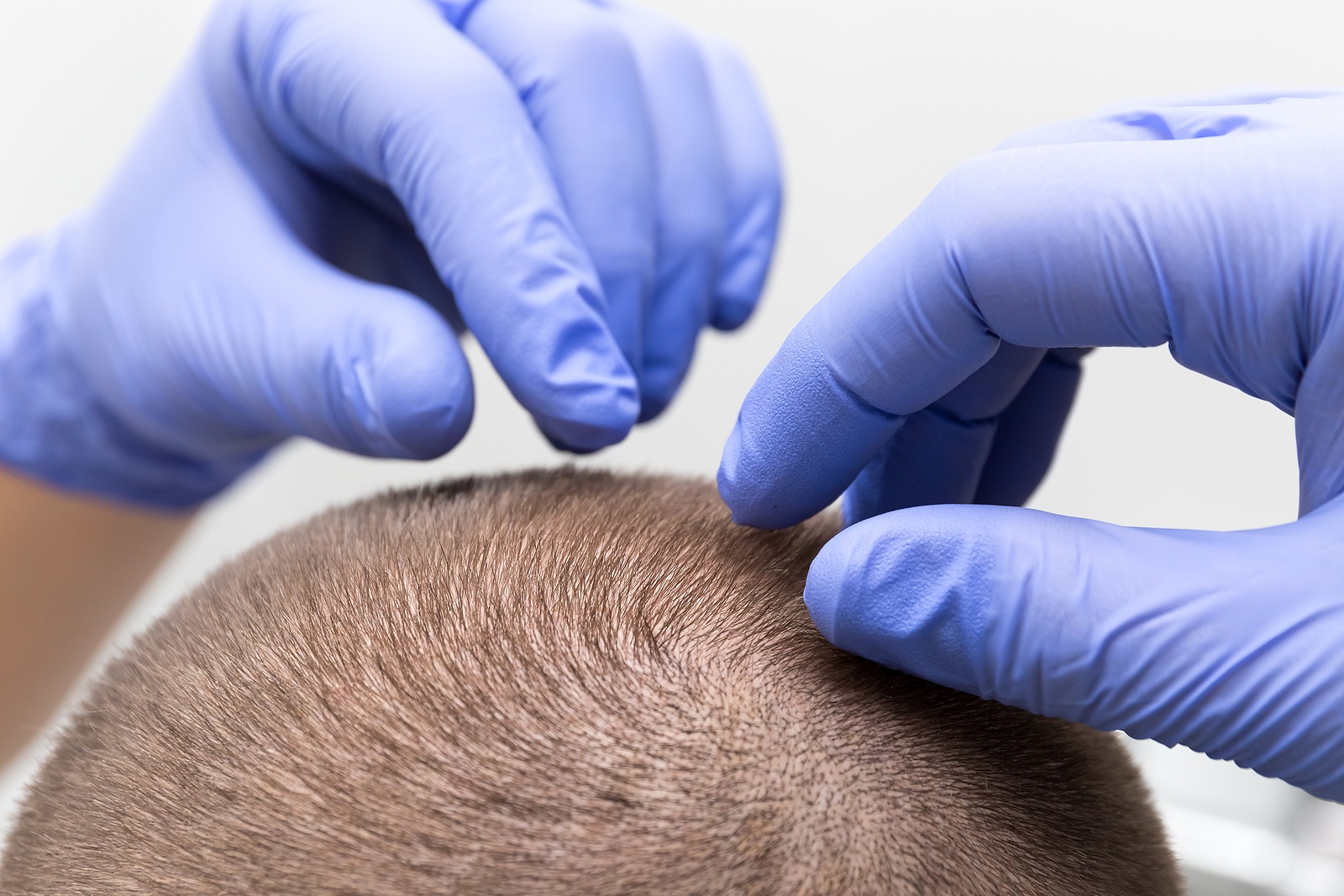 FUE Gold Haartransplantation Methode