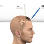 SDHI Haartransplantation