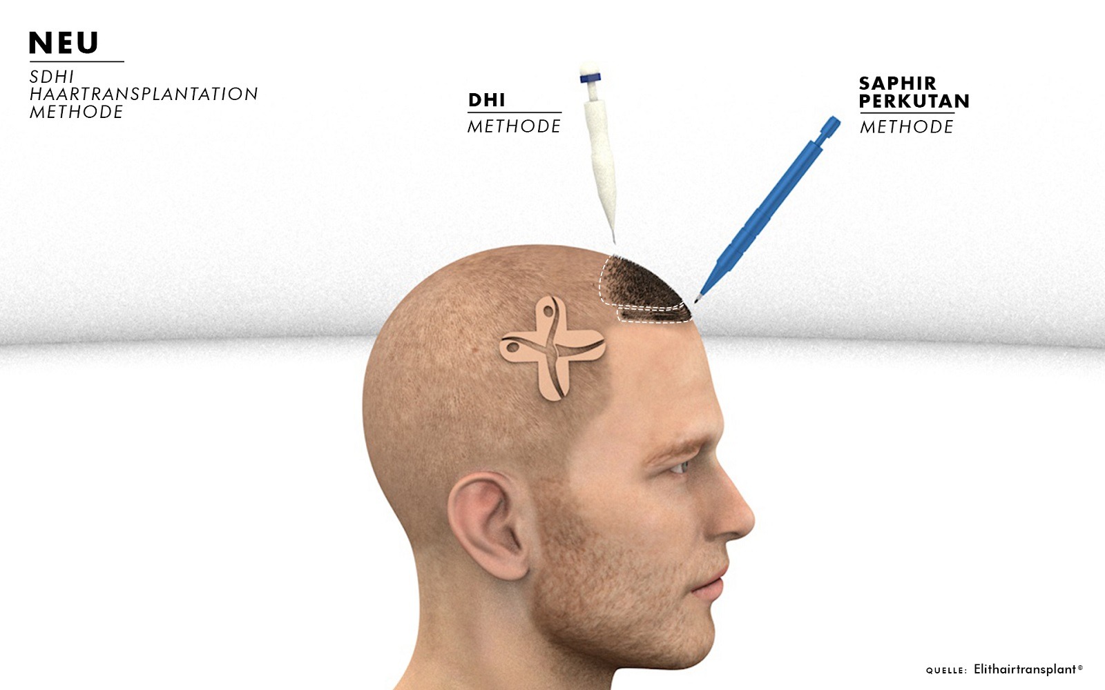 SDHI Haartransplantation