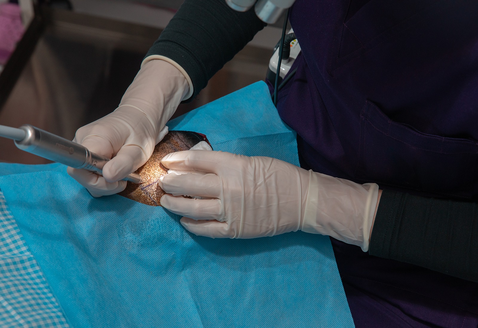 Haartransplantation nach der FUE-Methode