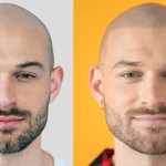 Haarpigmentierung Vorher Nachher Bild