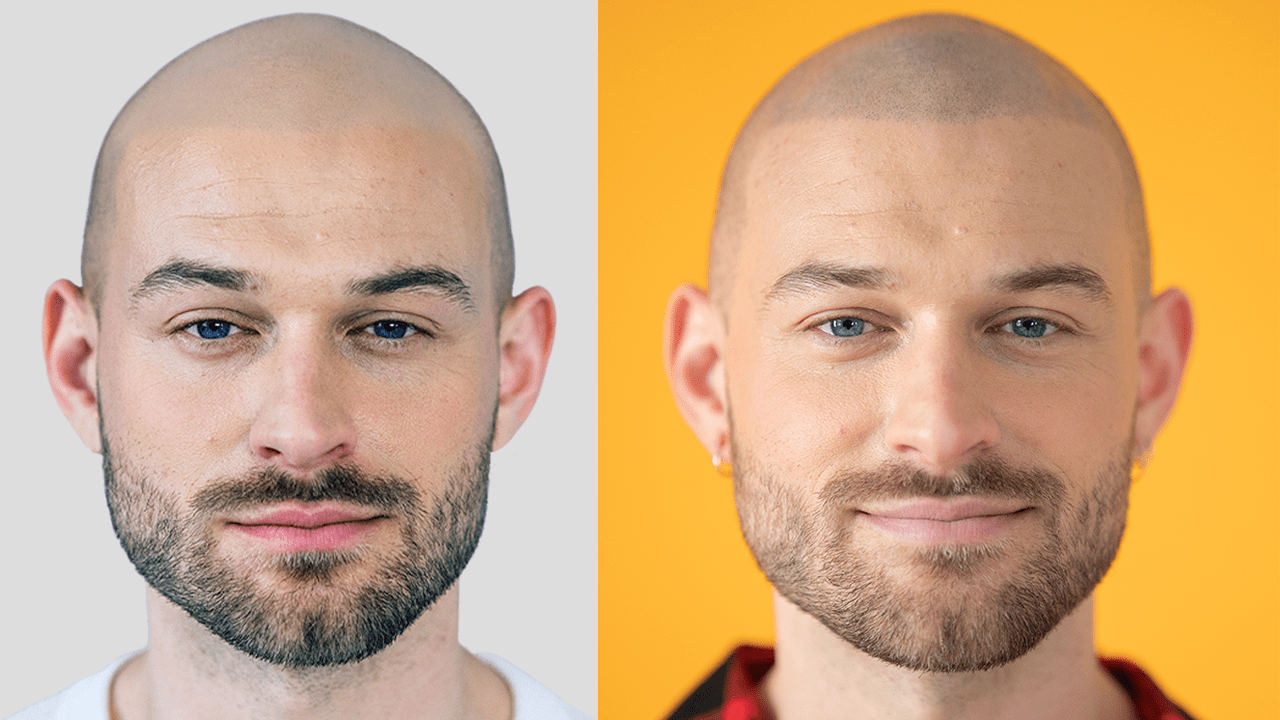 Haarpigmentierung Vorher Nachher Bild